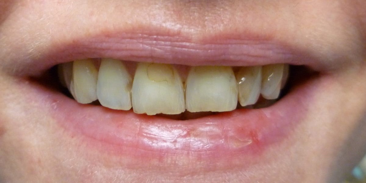 Sample before photo: a smile before veneers (not a patient of this practice)